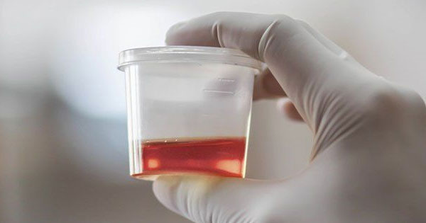 Know the possible causes for blood in the urine