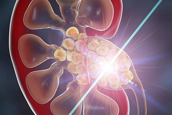 Laser Surgery for stone disease in Abu Dhabi